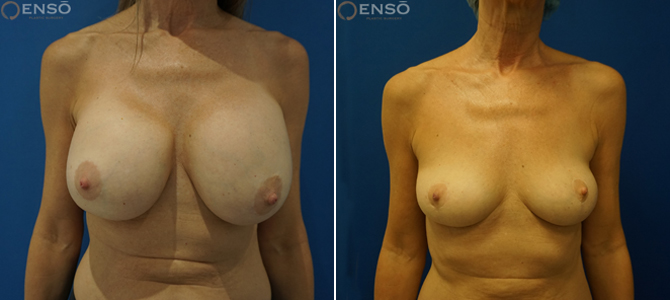 Case 10: 64-year-old female explant patient shown from the front before and after surgery with Dr. Dev.