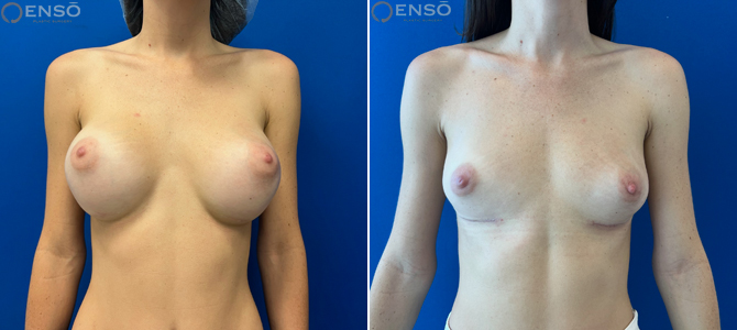 Case 3: 28-year-old explant patient, showing front view, before and after