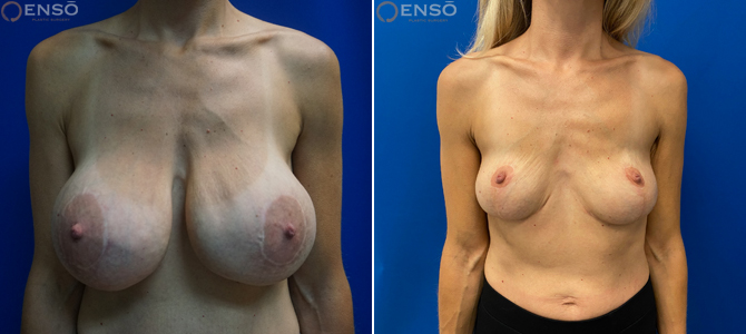 33-year-old woman, before and after view from the front after her explant