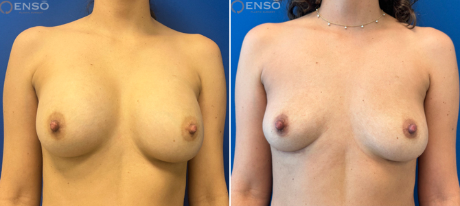 Case 5: 40-year-old female explant patient shown from the front before and after surgery at Enso