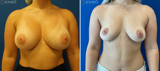 Case 6: 43-year-old female explant patient shown from the front before and after total capsulectomy.
