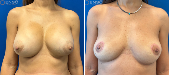Case 7: 53-year-old female explant patient shown before and after surgery from the front.