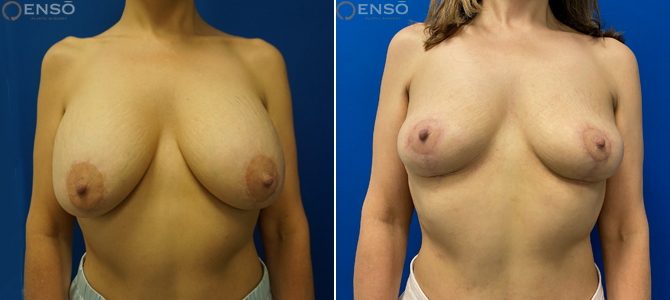 Case 8: 54-year-old female explant patient shown from the front before and after total capsulectomy at Enso.