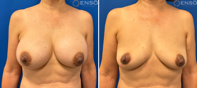 Case 9: 60-year-old female explant patient shown from the front before and after explant surgery with Dr. Dev.