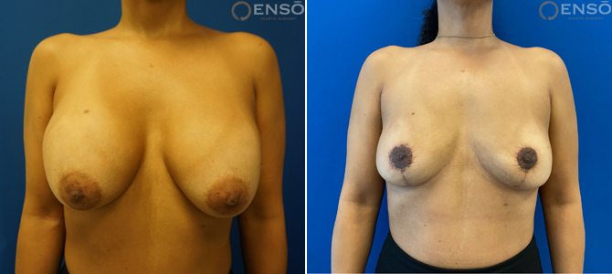 28-year-old female, 1 month after Explant with Total Capsulectomy and Lollipop Lift; combo before and after