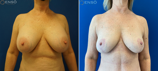 Case 11: 50-year-old female explant patient shown from the front before and after total capsulectomy with anchor pattern breast lift.