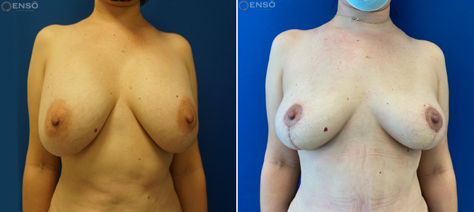 Case 12: 44-year-old female explant patient shown from the front before and after an explant with total capsulectomy and lollipop breast lift. She also did a tummy tuck with liposuction.