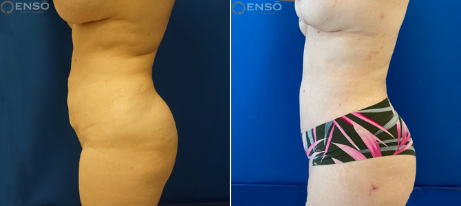 Case 2 Tummy: 44-year-old female tummy tuck with liposuction of flanks and upper back shown from the side before and after surgery.
