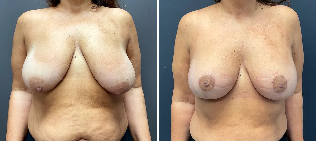 ENSO Breast Lift (Mastopexy) Before and After Case 1 image 1