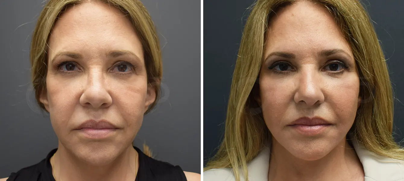 ENSO Facelift Plus Rhinoplasty Before and After Case 1 image 1