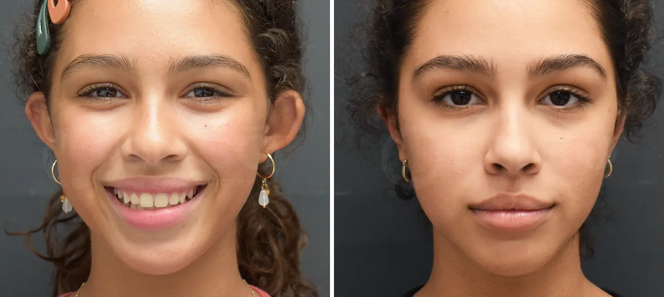 ENSO Otoplasty Before and After Case 1 Image 1