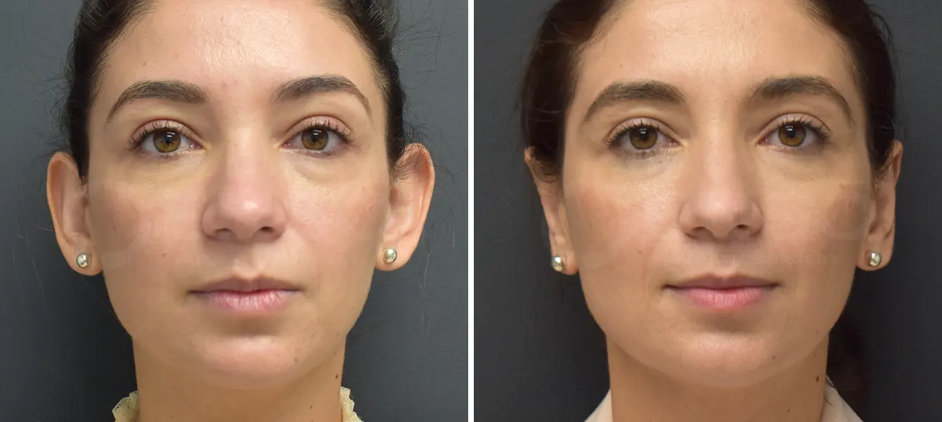 ENSO Otoplasty Before and After Case 3 Image 1