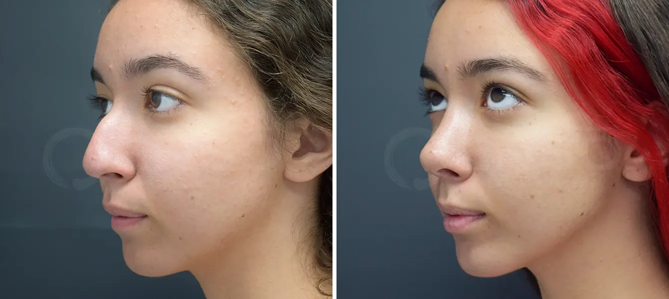 Rhinoplasty (Nose Surgery) Before & After Case #1-3
