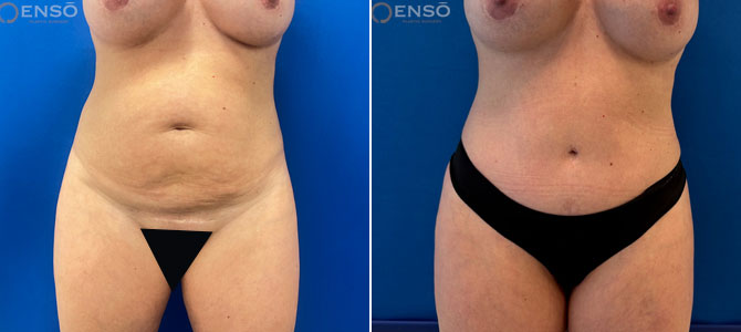 Case3 Age44 Tummy Liposuction Front COMBO C