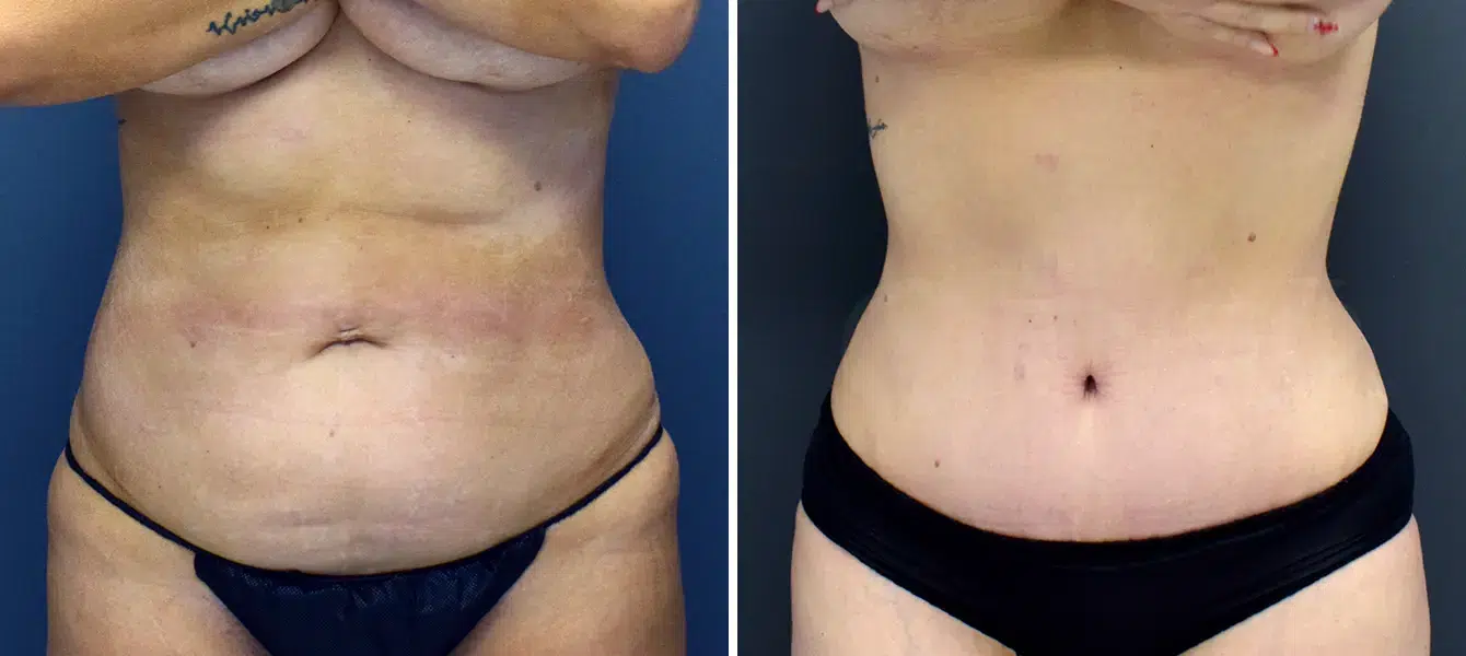 ENSO Tummy Tuck (Abdominoplasty) Before and After Case 1 image 4