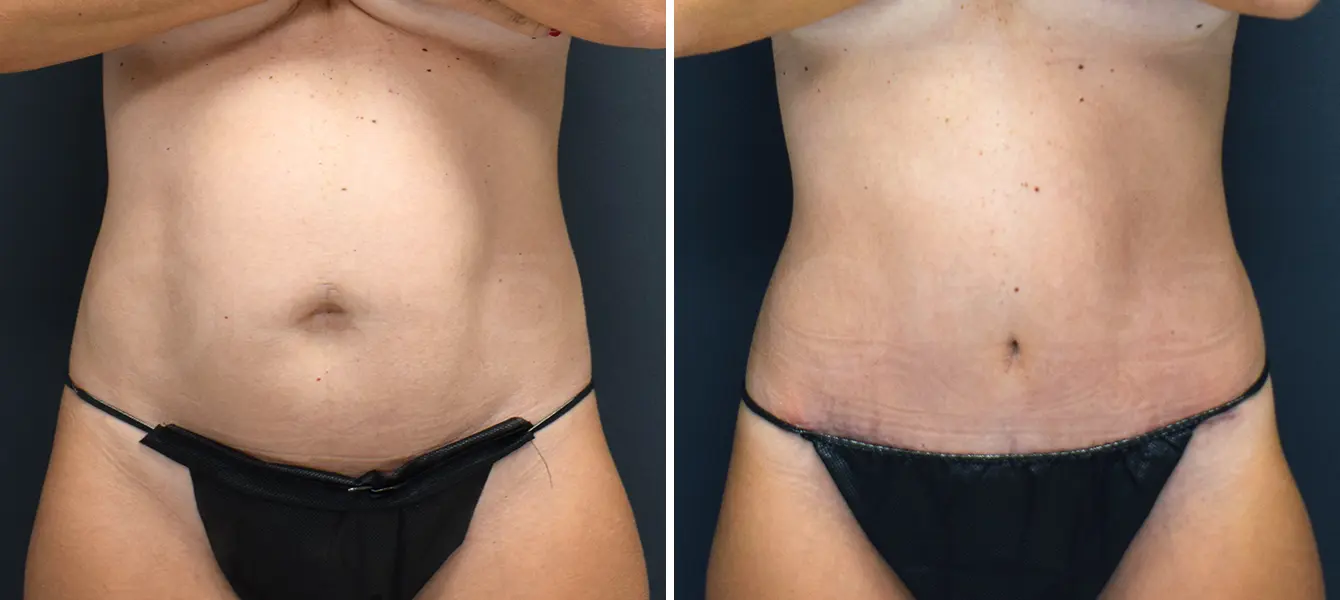 ENSO Tummy Tuck (Abdominoplasty) Before and After Case 2 image 3
