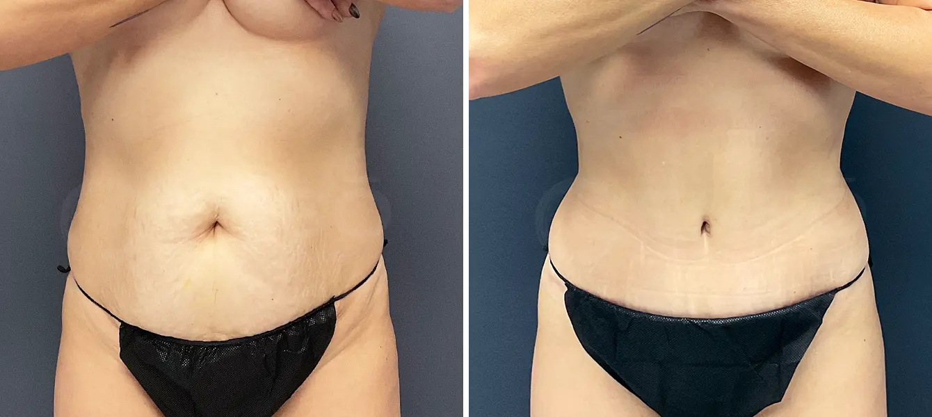 ENSO Tummy Tuck (Abdominoplasty) Before and After Case 4 image 5