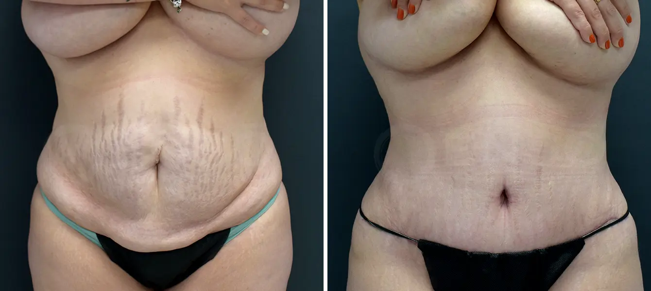 ENSO Tummy Tuck (Abdominoplasty) Before and After Case 3 image 1