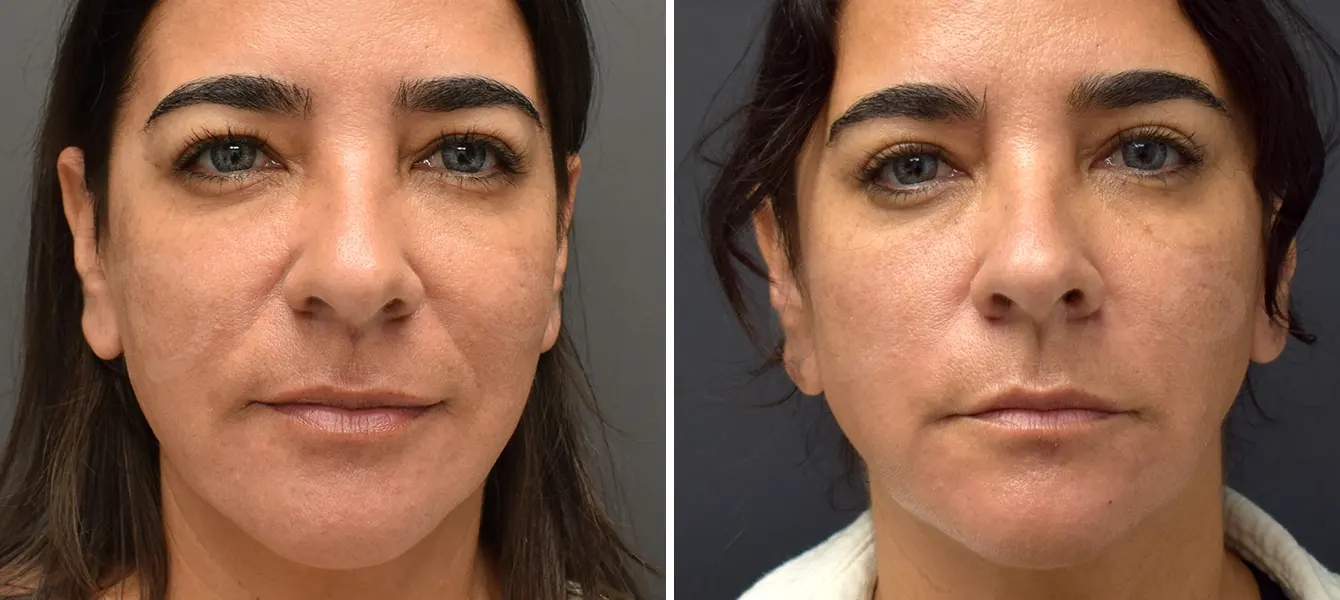 ENSO Eyelid Surgery (Blepharoplasty) Before and After Case 2 image 1