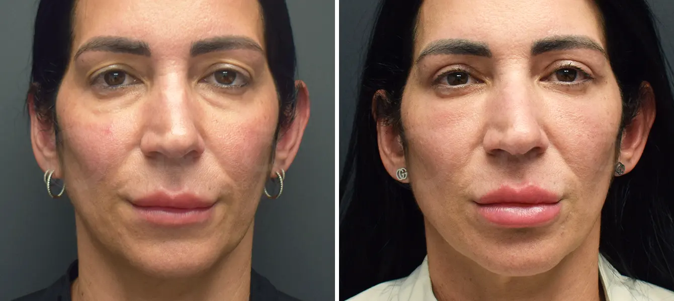 ENSO Eyelid Surgery (Blepharoplasty) Before and After Case 3 image 1