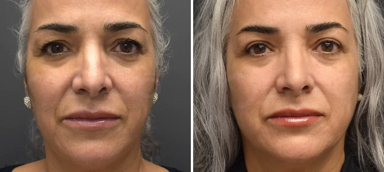 ENSO Eyelid Surgery (Blepharoplasty) Before and After Case 4 image 1