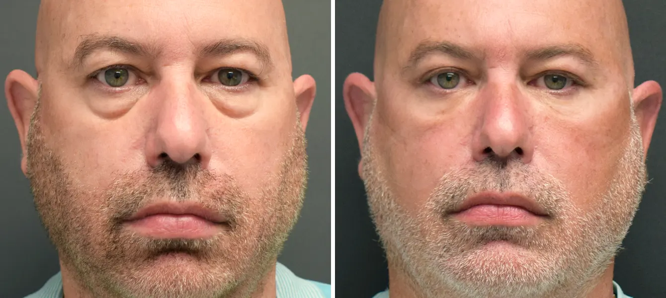 ENSO Eyelid Surgery (Blepharoplasty) Before and After Case 1 image 2