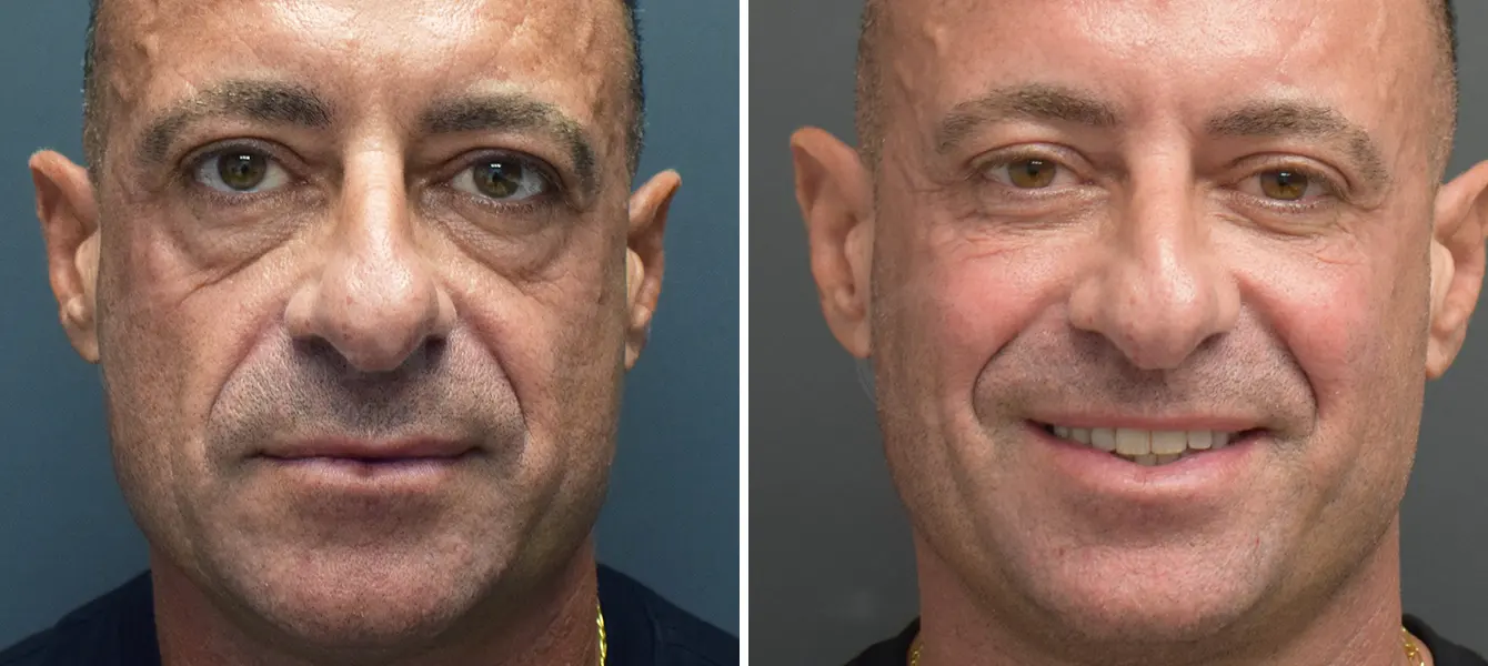 ENSO Eyelid Surgery (Blepharoplasty) Before and After Case 6 image 1