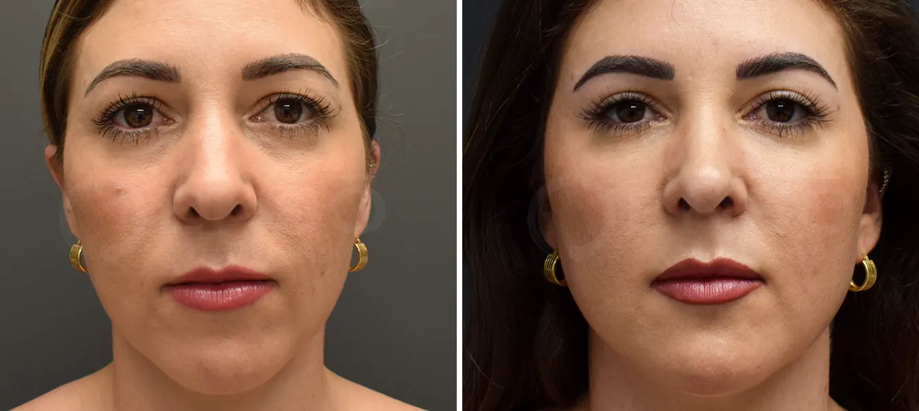 ENSO Eyelid Surgery (Blepharoplasty) Before and After Case 5 image 3