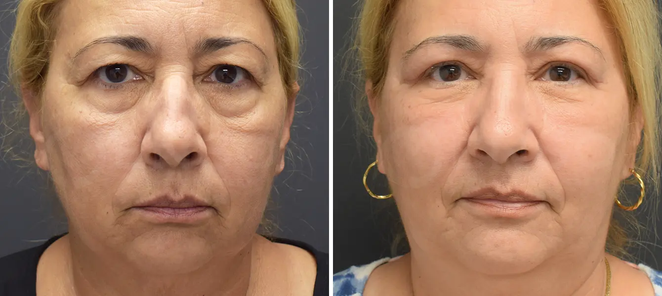 ENSO Eyelid Surgery (Blepharoplasty) Before and After Case 7 image 1