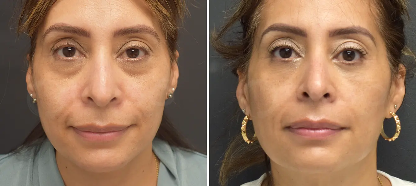 ENSO Eyelid Surgery (Blepharoplasty) Before and After Case 8 image 1