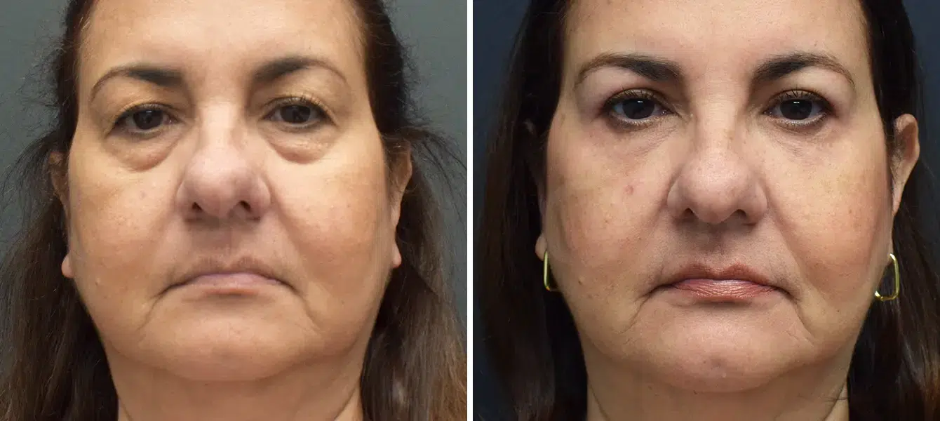 ENSO Eyelid Surgery (Blepharoplasty) Before and After Case 9 image 1