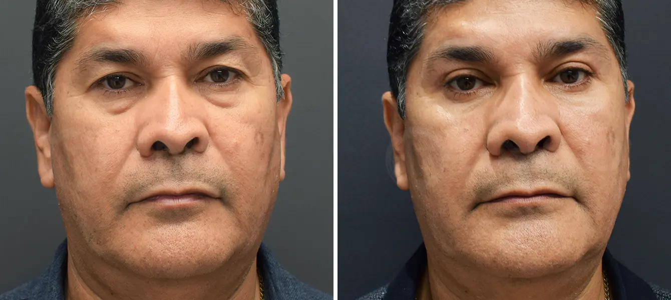 ENSO Eyelid Surgery (Blepharoplasty) Before and After Case 10 image 1