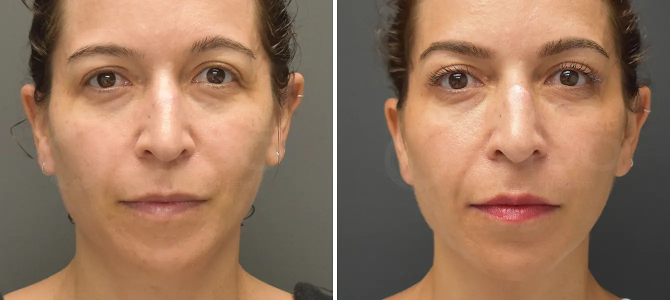 ENSO Eyelid Surgery (Blepharoplasty) Before and After Case 11 image 1