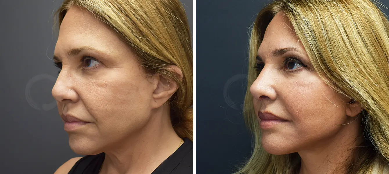 ENSO Facelift Plus Rhinoplasty Before and After Case 1 image 3