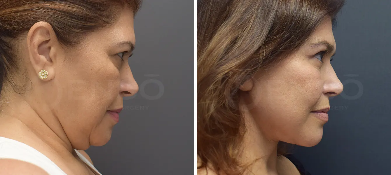 Before and after photo of ENSO Facelift with upper and lower blepharoplasty – Case 1, image 3