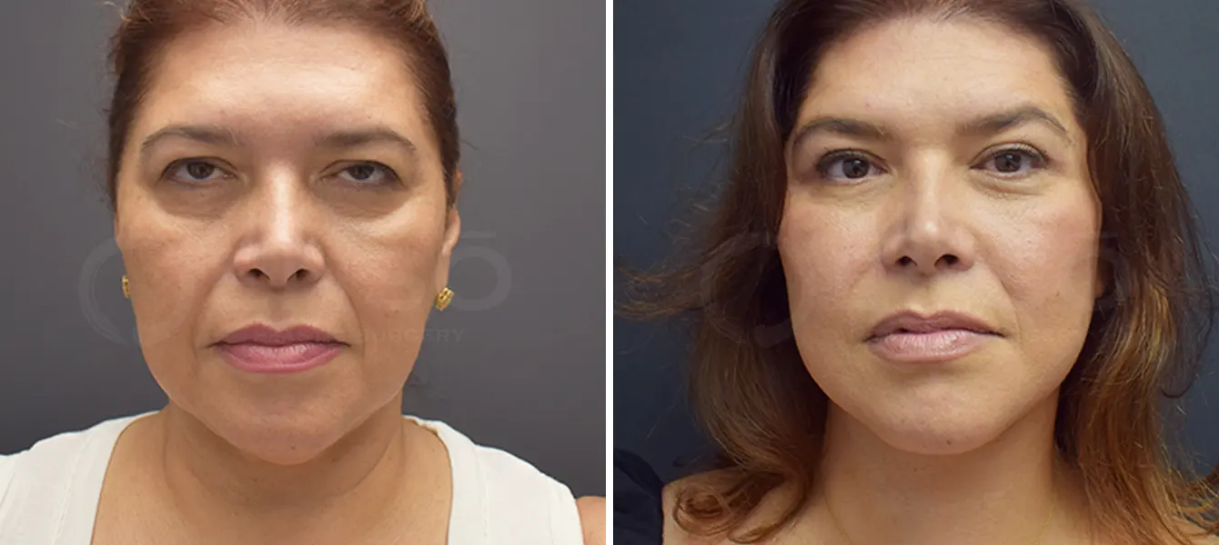 Before and after photo of ENSO Facelift with upper and lower blepharoplasty – Case 1, image 1 Before and after photo of ENSO Facelift with upper and lower blepharoplasty – Case 1, image 1