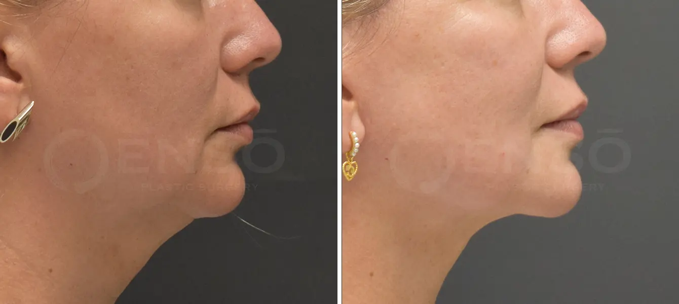 ENSO Facelift Before and After Case 4 image 1