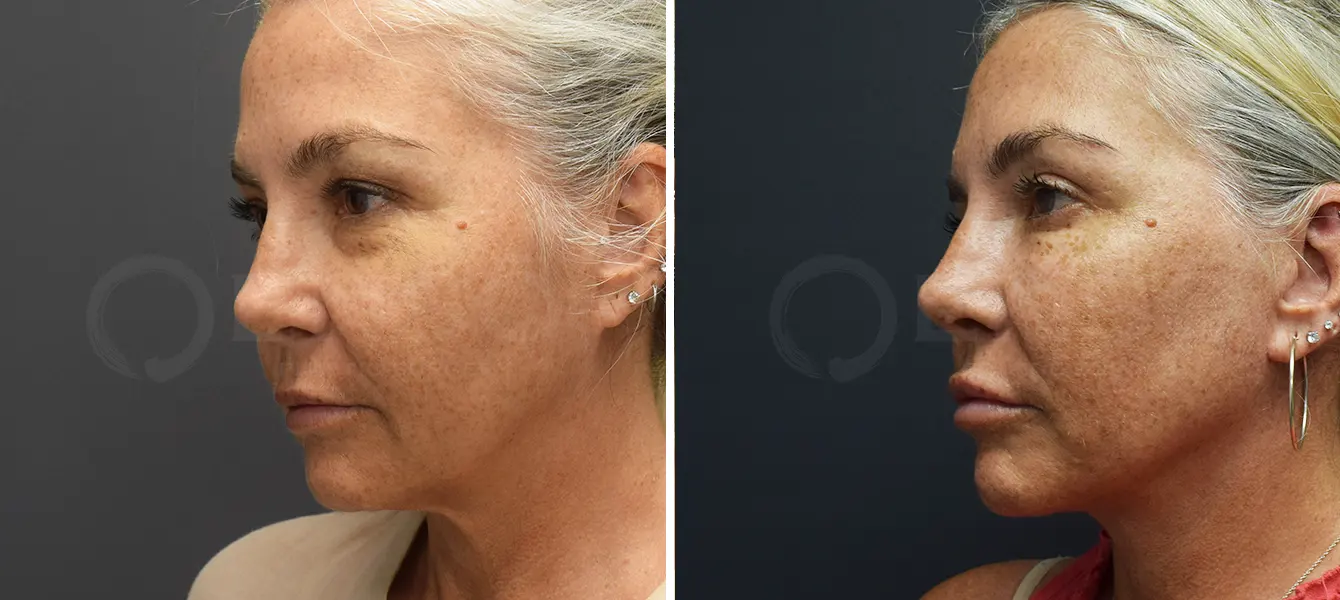 Before and after photo of ENSO Facelift with upper and lower blepharoplasty – Case 2, image 2