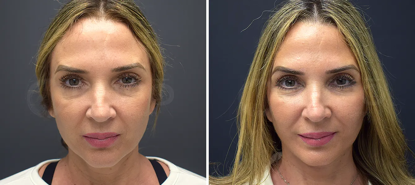 ENSO Facelift Before and After Case 1 image 1