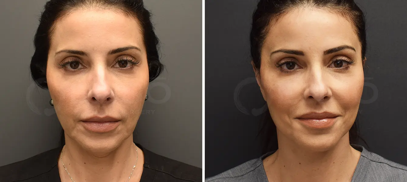 ENSO Facelift Before and After Case 5 image 3