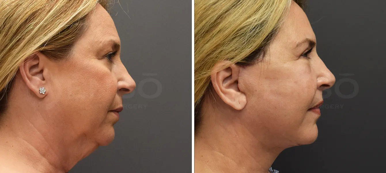 Before and after photo of ENSO Facelift with upper and lower blepharoplasty – Case 3, image 2