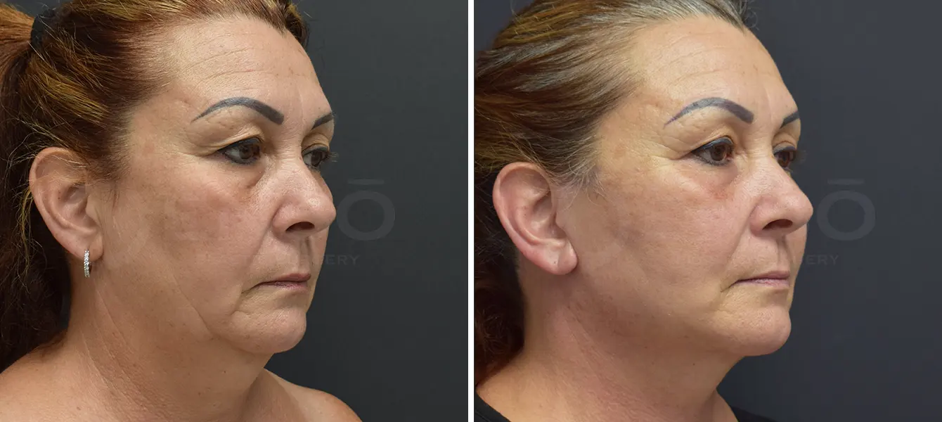 ENSO Facelift Before and After Case 2 image 1