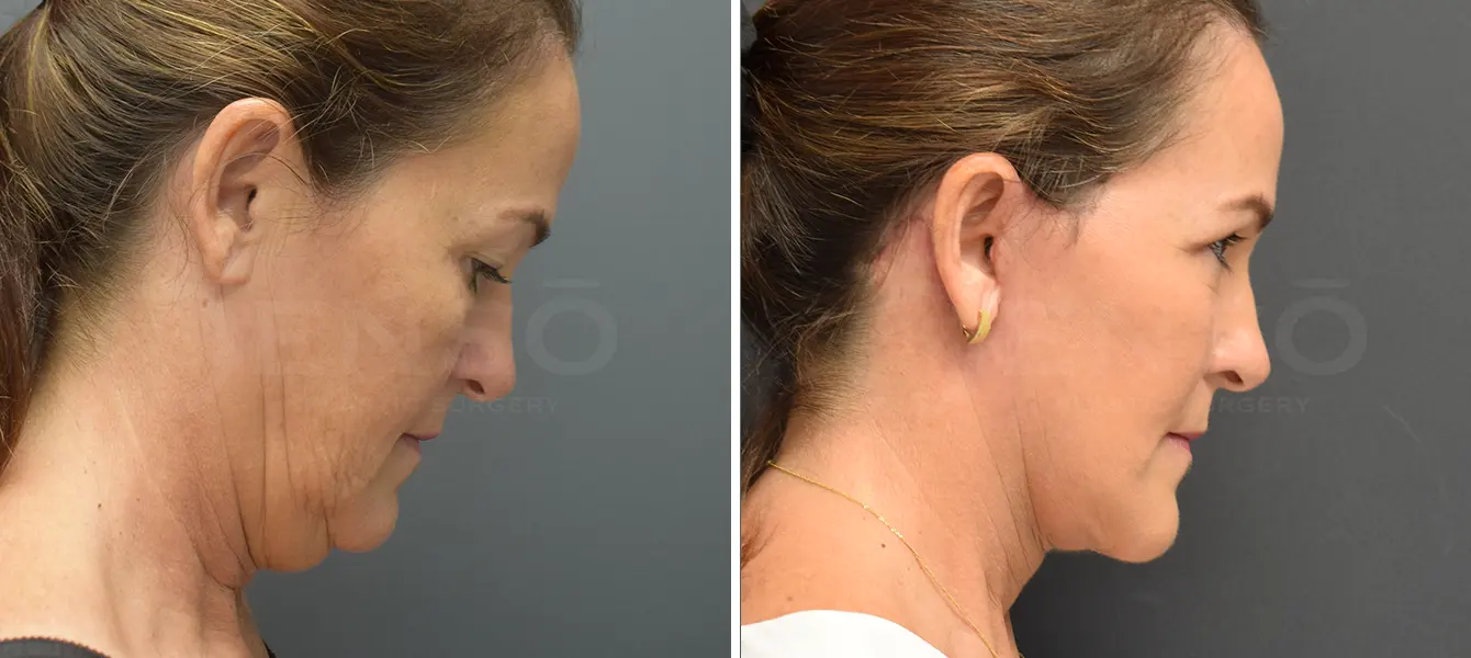 ENSO Facelift Before and After Case 6 image 2