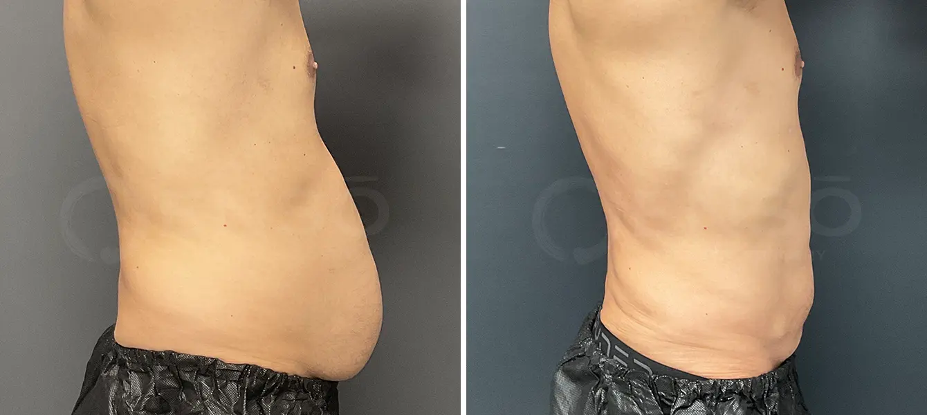 ENSO Liposuction Before and After Case 6 image 3