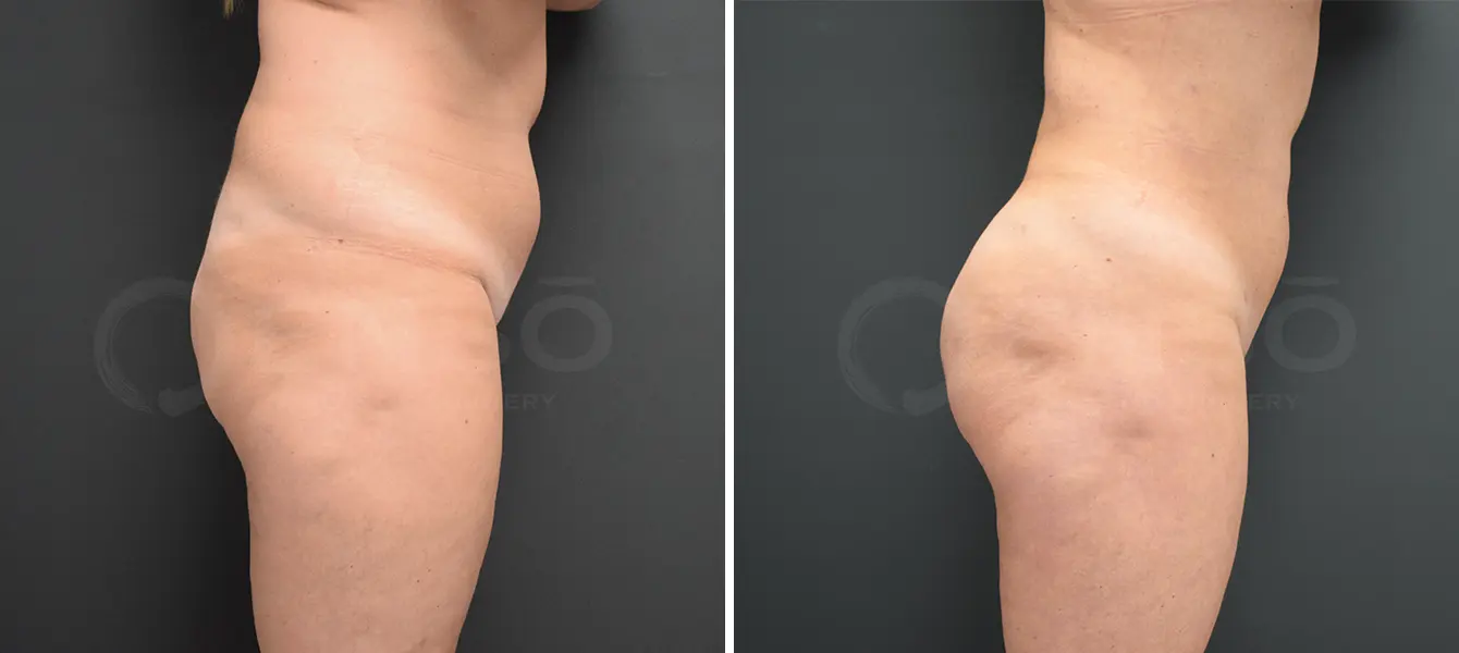 ENSO Liposuction Before and After Case 5 image 2