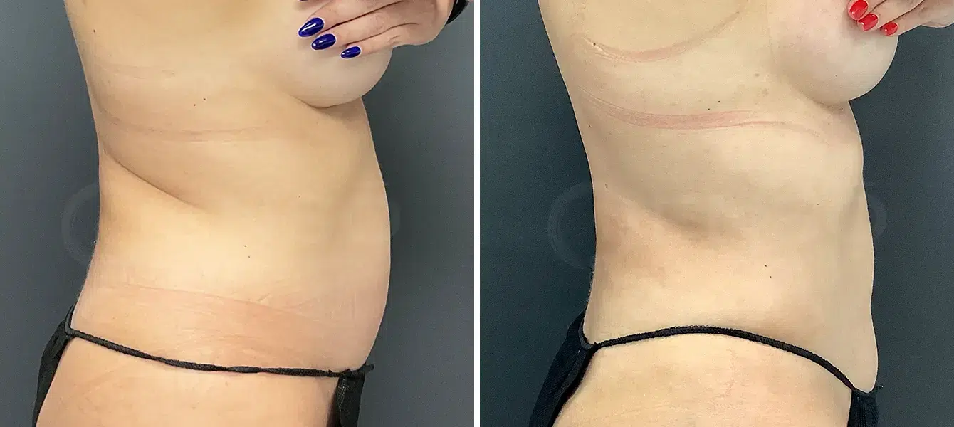 ENSO Liposuction Before and After Case 1 image 3