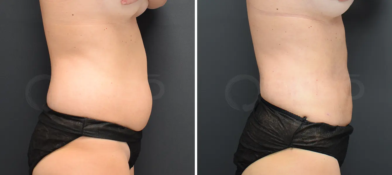 ENSO Liposuction Before and After Case 3 image 2