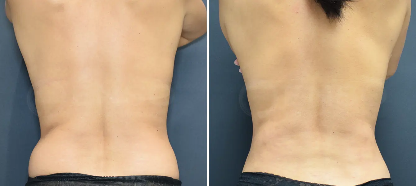 ENSO Liposuction Before and After Case 2 image 1