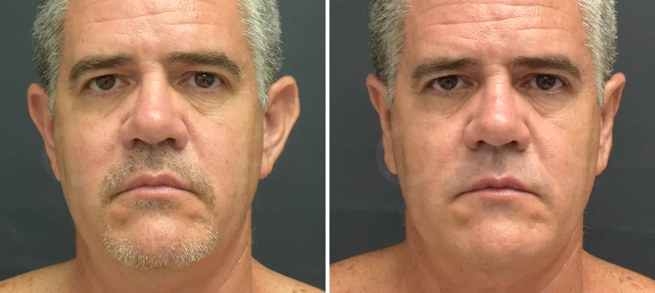 ENSO Otoplasty Before and After Case 2 Image 1