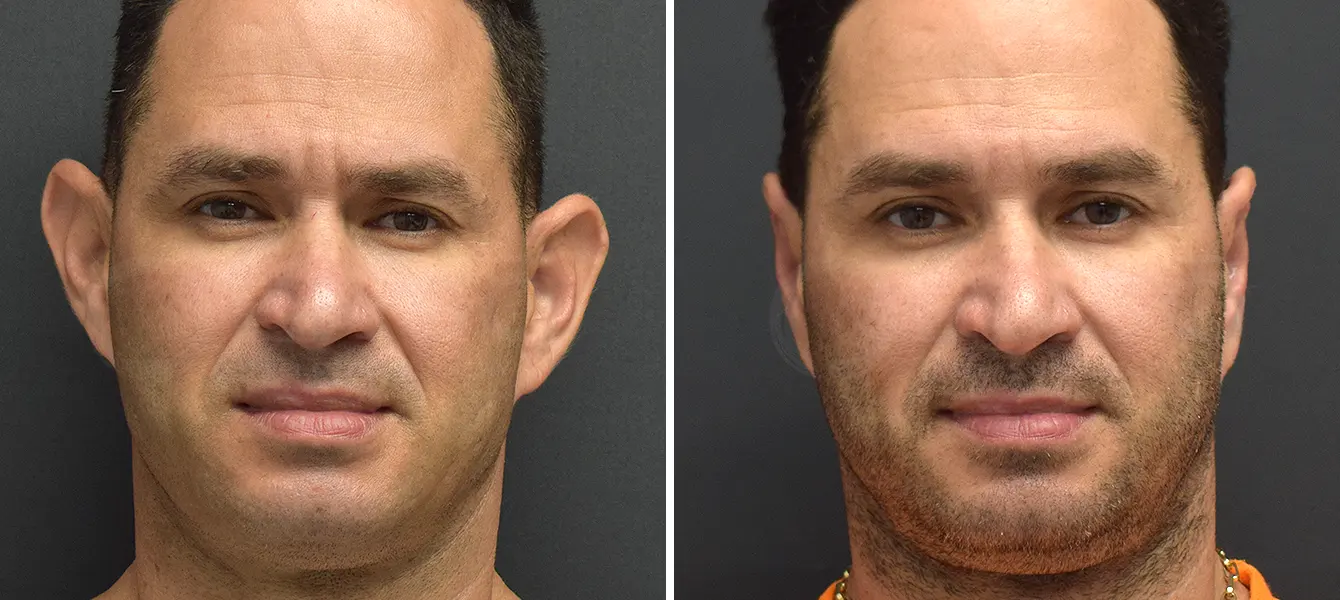 ENSO Otoplasty Before and After Case 4 Image 1